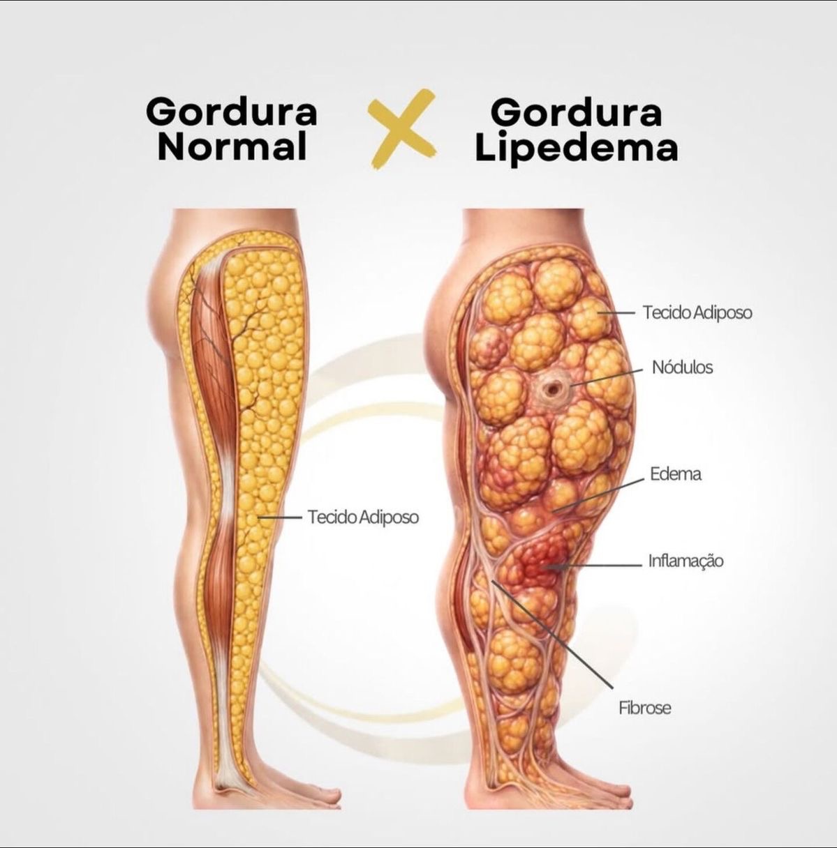 Gordura comum × lipedema