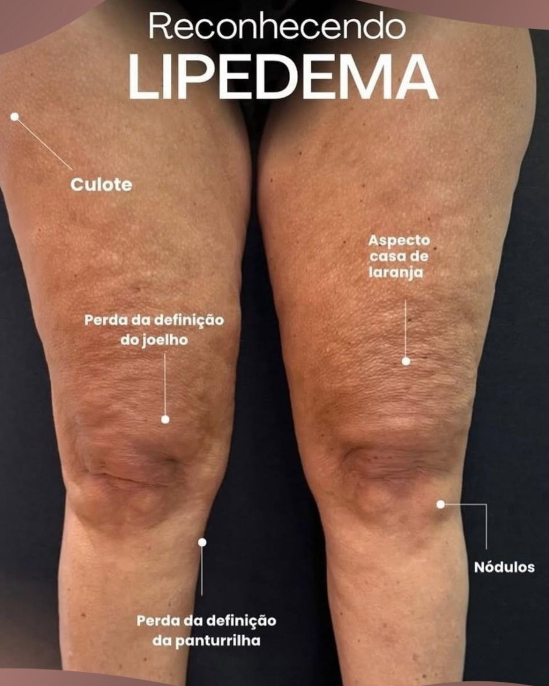 Reconhecendo o lipedema